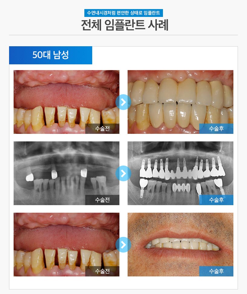 분당임플란트 - 전체임플란트 후기/사례 1 : 50대 남성