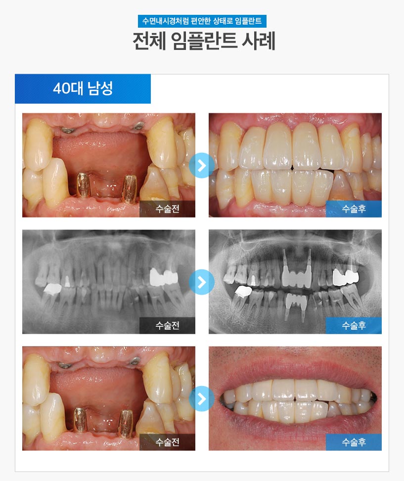 분당임플란트 - 전체임플란트 후기/사례 2 : 40대 남성