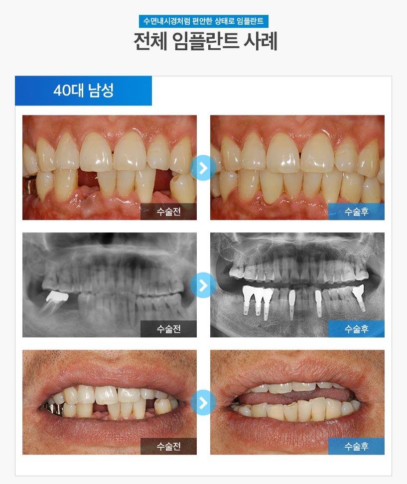 분당임플란트 - 전체임플란트 후기/사례 3 : 40대 남성