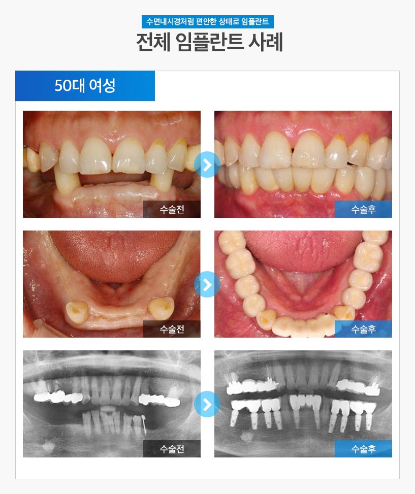 분당임플란트 - 전체임플란트 후기/사례 4 : 50대 여성