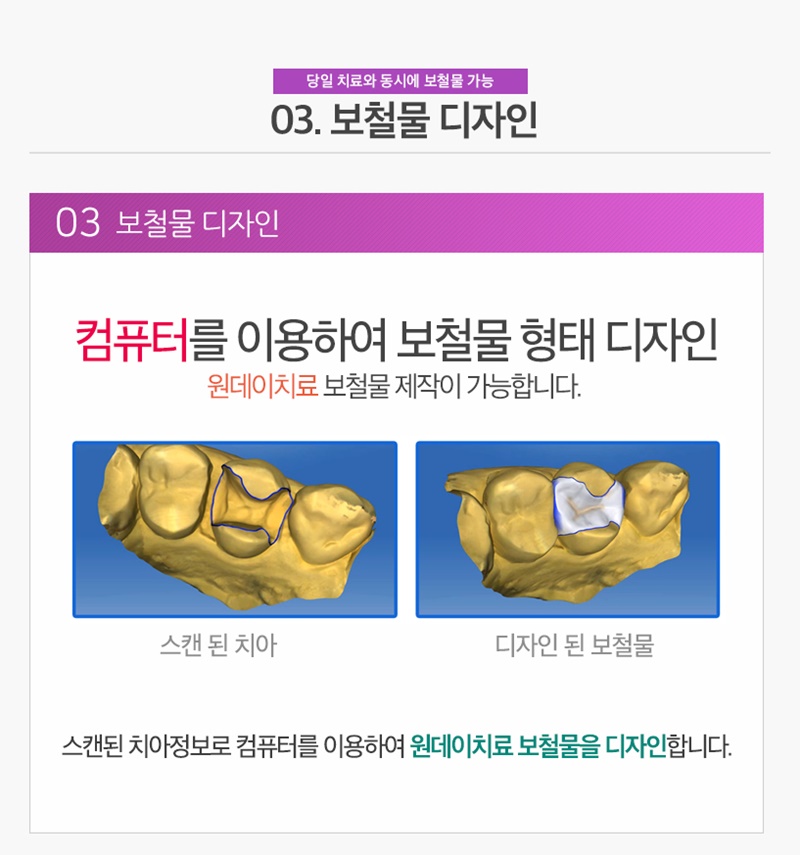 수면마취치과/원데이치과 - 원데이치료과정 : 03. 컴퓨터를 이용한 보철물 형태 디자인