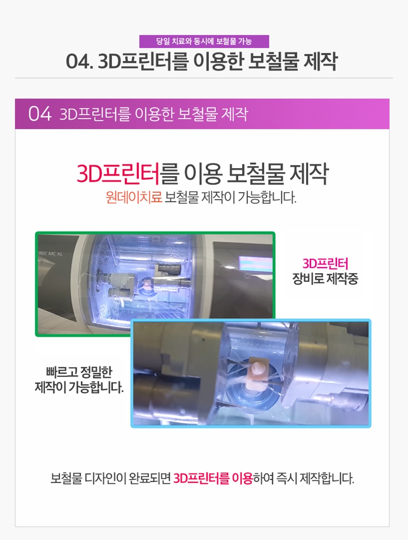 수면마취치과/원데이치과 - 원데이치료과정 : 03. CAD/CAM을 이용한 당일 보철물 제작