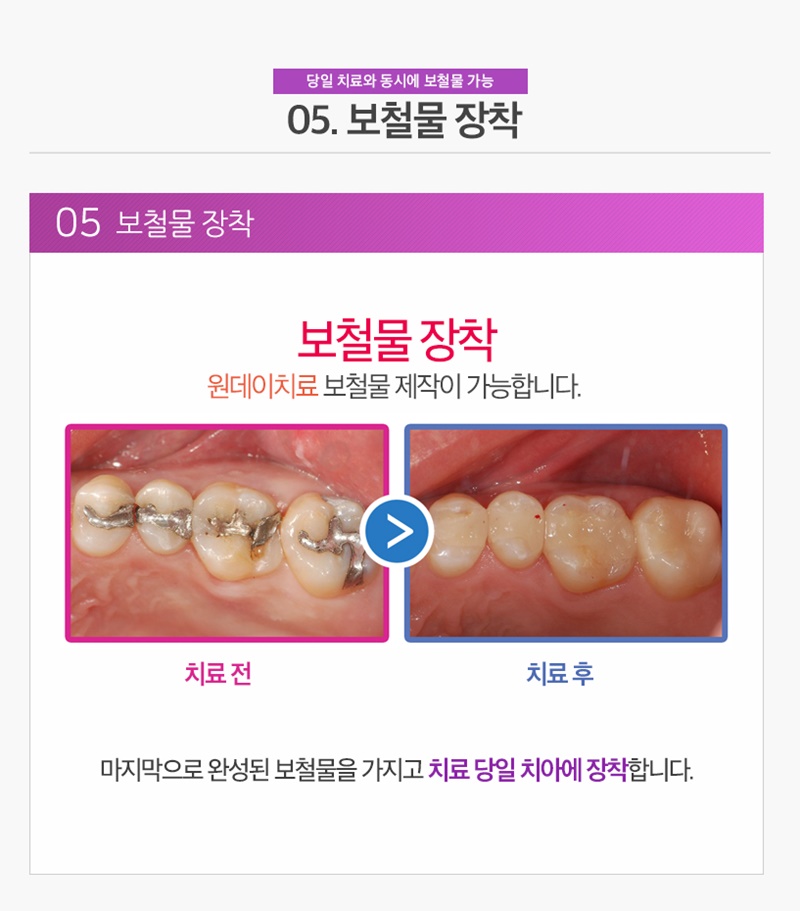 수면마취치과/원데이치과 - 원데이치료과정 : 05. 당일 보철물 제작
