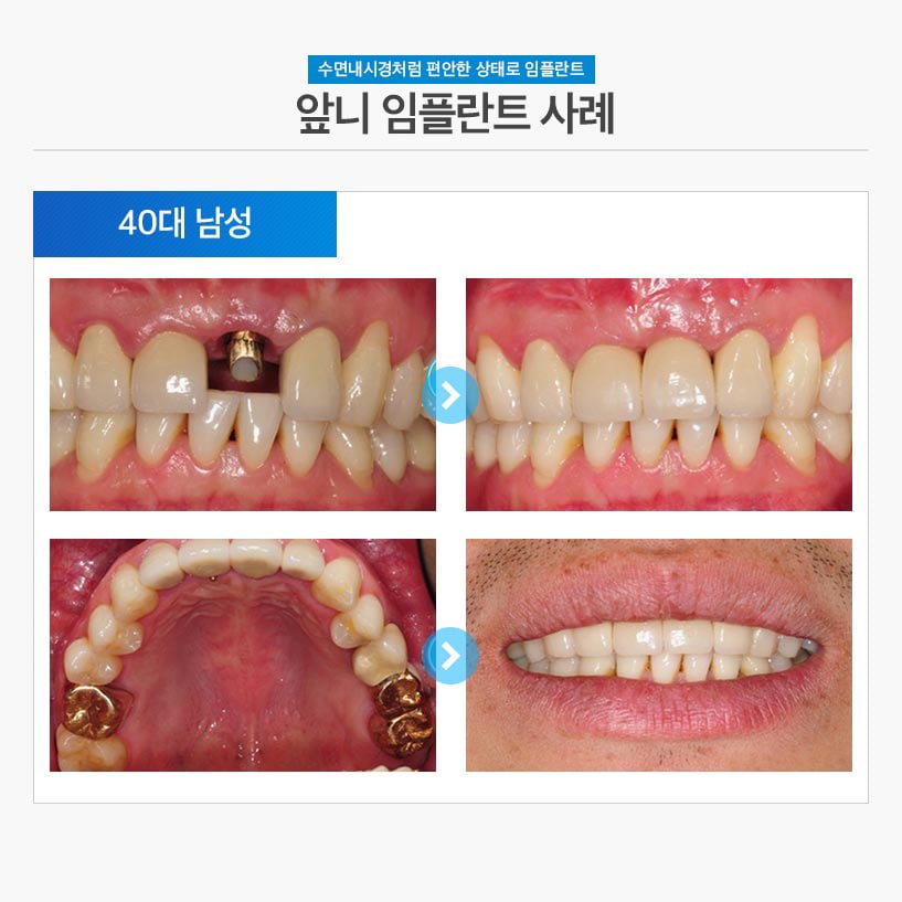 수면임플란트사례03