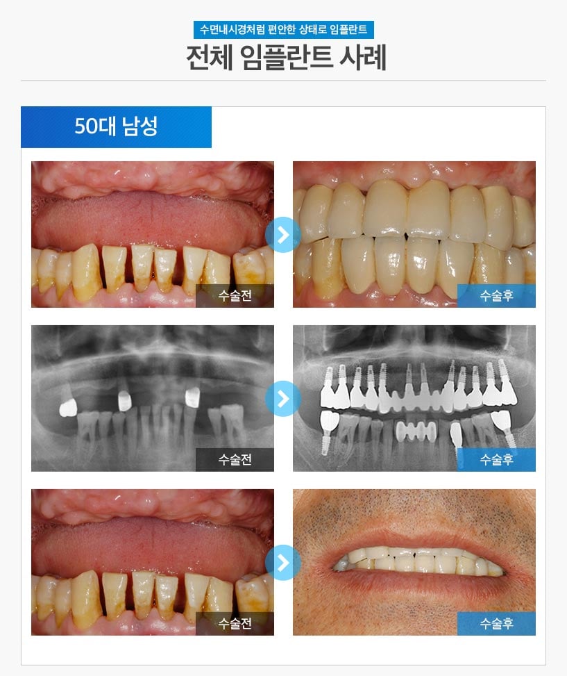 수면임플란트사례06