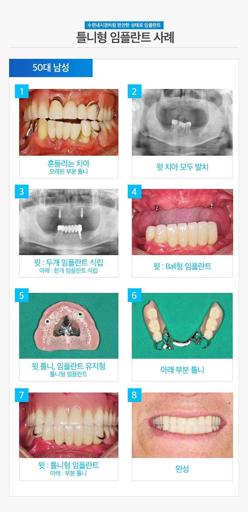 수면임플란트사례08