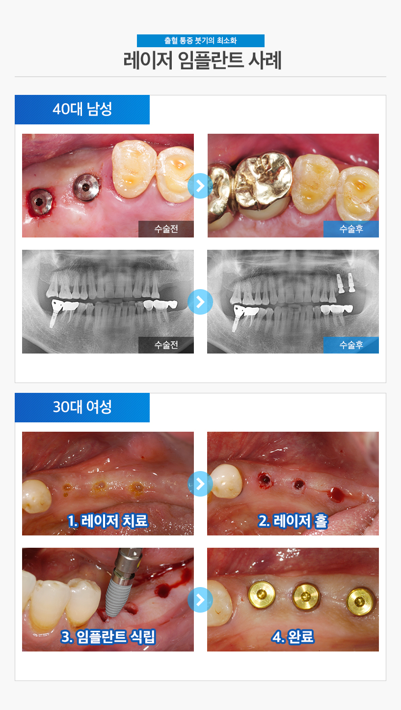 수면임플란트사례09