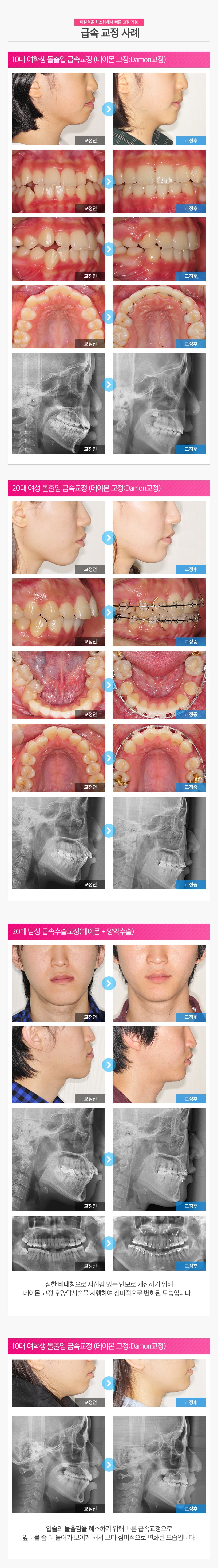 급속교정치료사례01