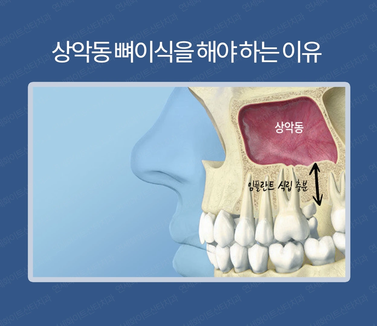 상악동 뼈이식을 해야하는 이유 1 - 뼈이식임플란트