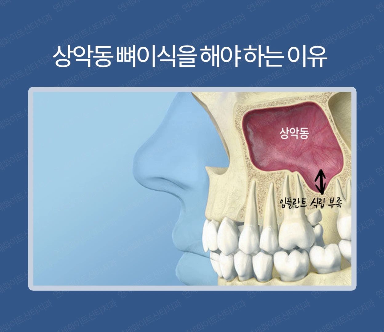 상악동 뼈이식을 해야하는 이유 2 - 뼈이식임플란트