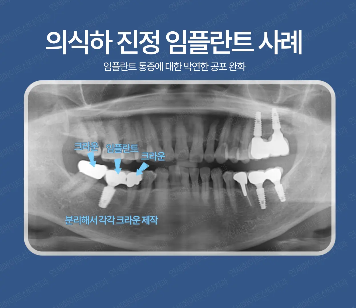 임플란트 통증 - 의식하 진정임플란트 사례1