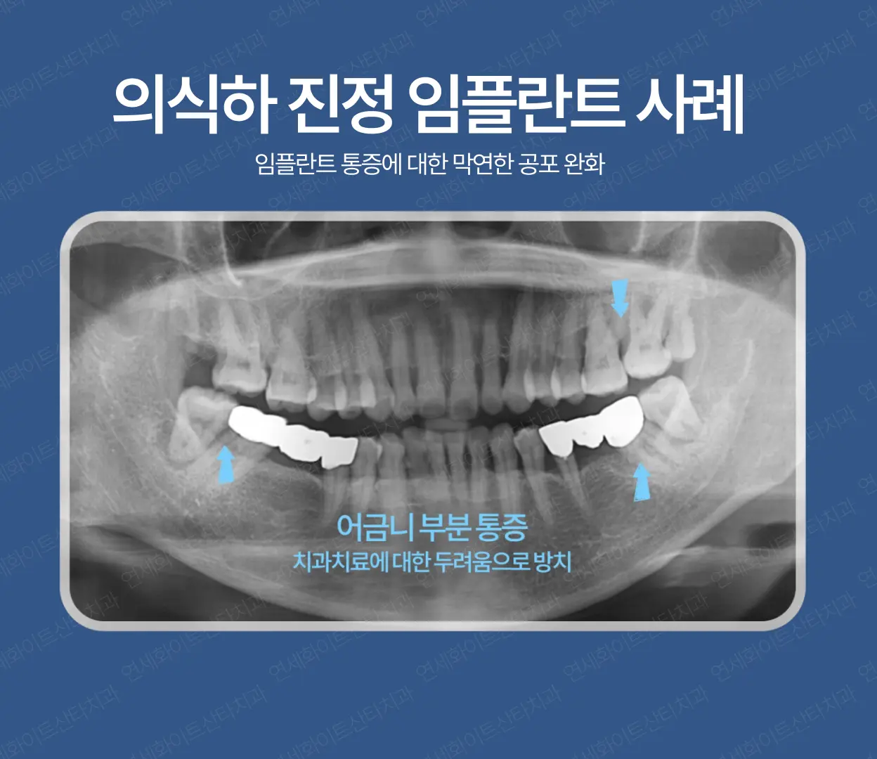 임플란트 통증 - 의식하 진정임플란트 사례1