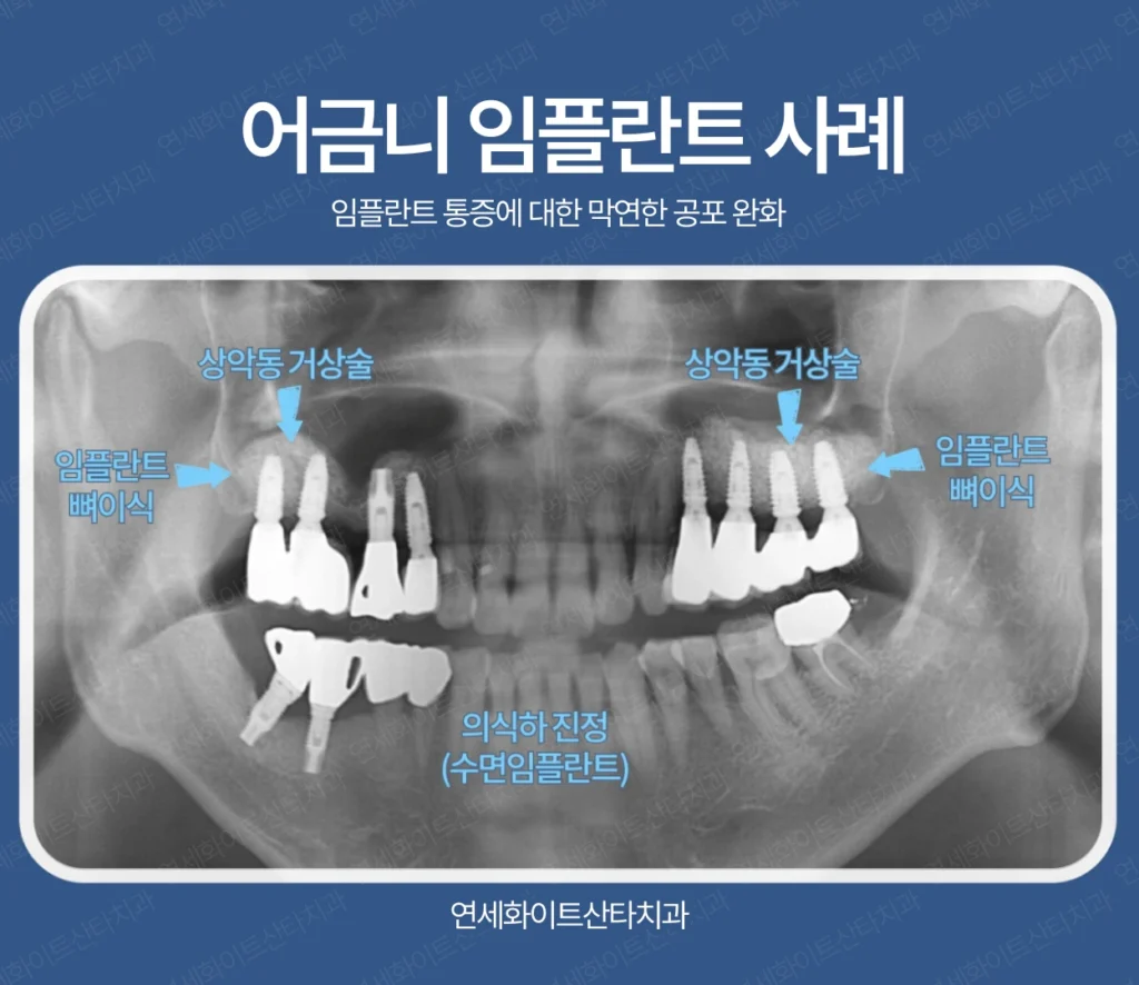 분당치과 - 어금니임플란트 사례 -2