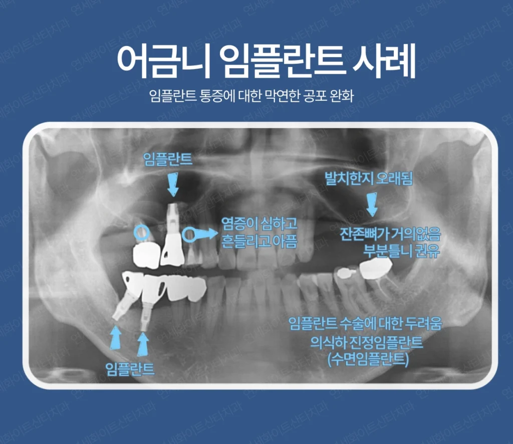 분당치과 - 어금니임플란트 사례 -1