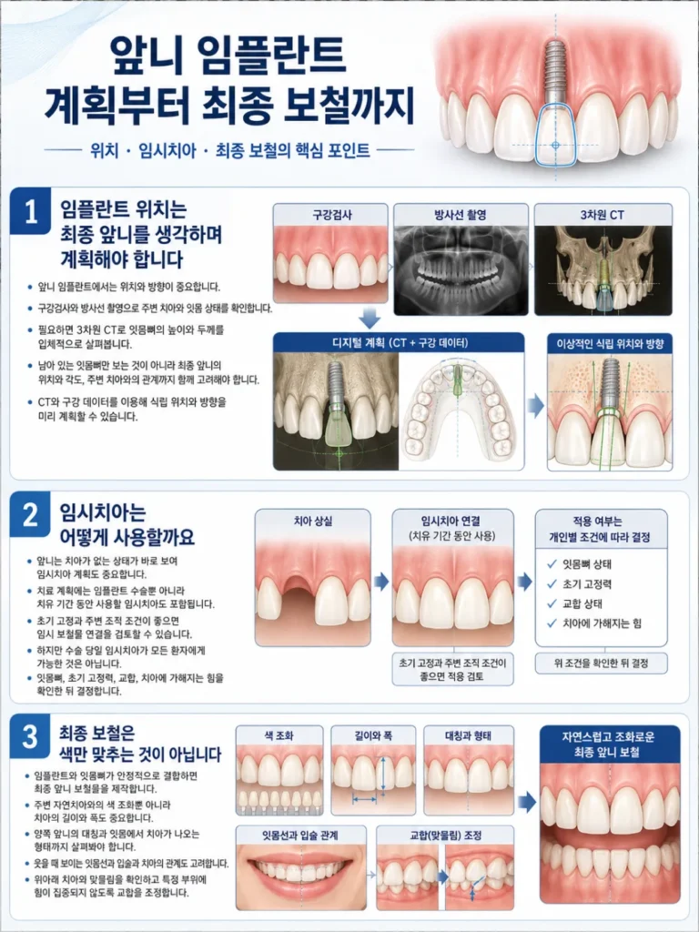 분당앞니임플란트 - 생각해야할것