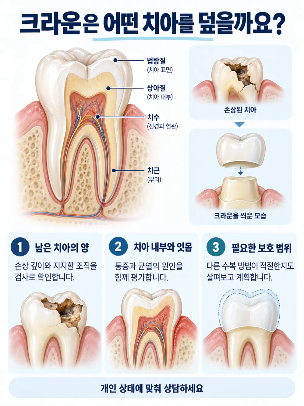 크라운은 어떤 치아를 덮을까요?: 남은 치아의 양, 치아 내부와 잇몸, 필요한 보호 범위