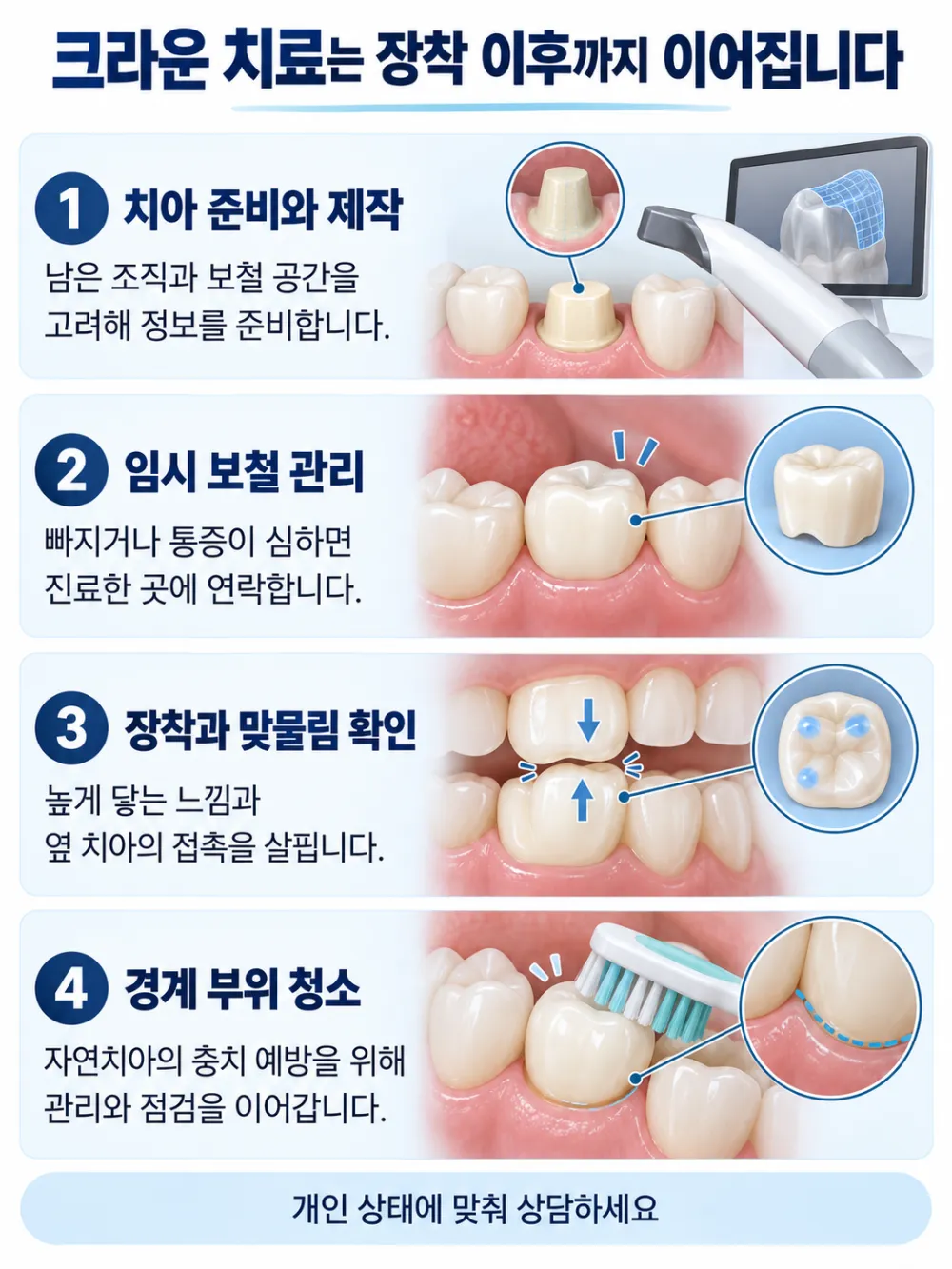 크라운 치료는 장착 이후까지 이어집니다: 치아 준비와 제작, 임시 보철 관리, 장착과 맞물림 확인, 경계 부위 청소