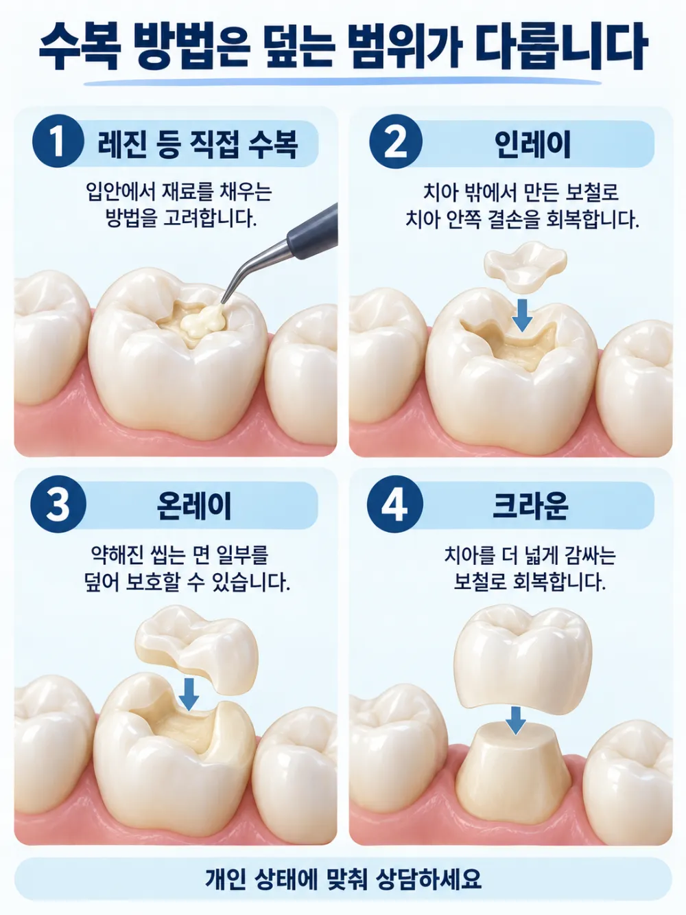수복 방법은 덮는 범위가 다릅니다: 레진 등 직접 수복, 인레이, 온레이, 크라운