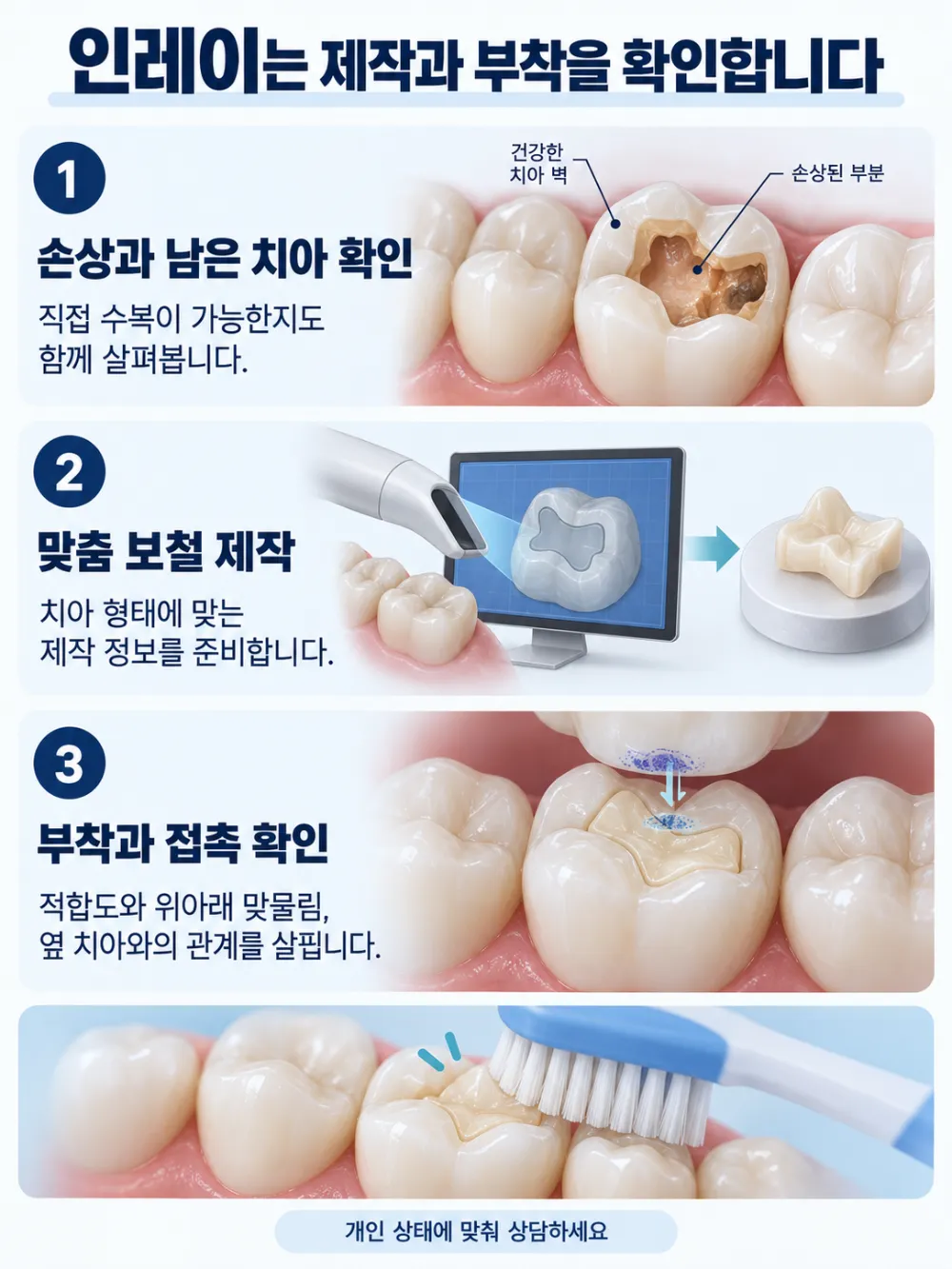 인레이는 제작과 부착을 확인합니다: 손상과 남은 치아 확인, 맞춤 보철 제작, 부착과 접촉 확인