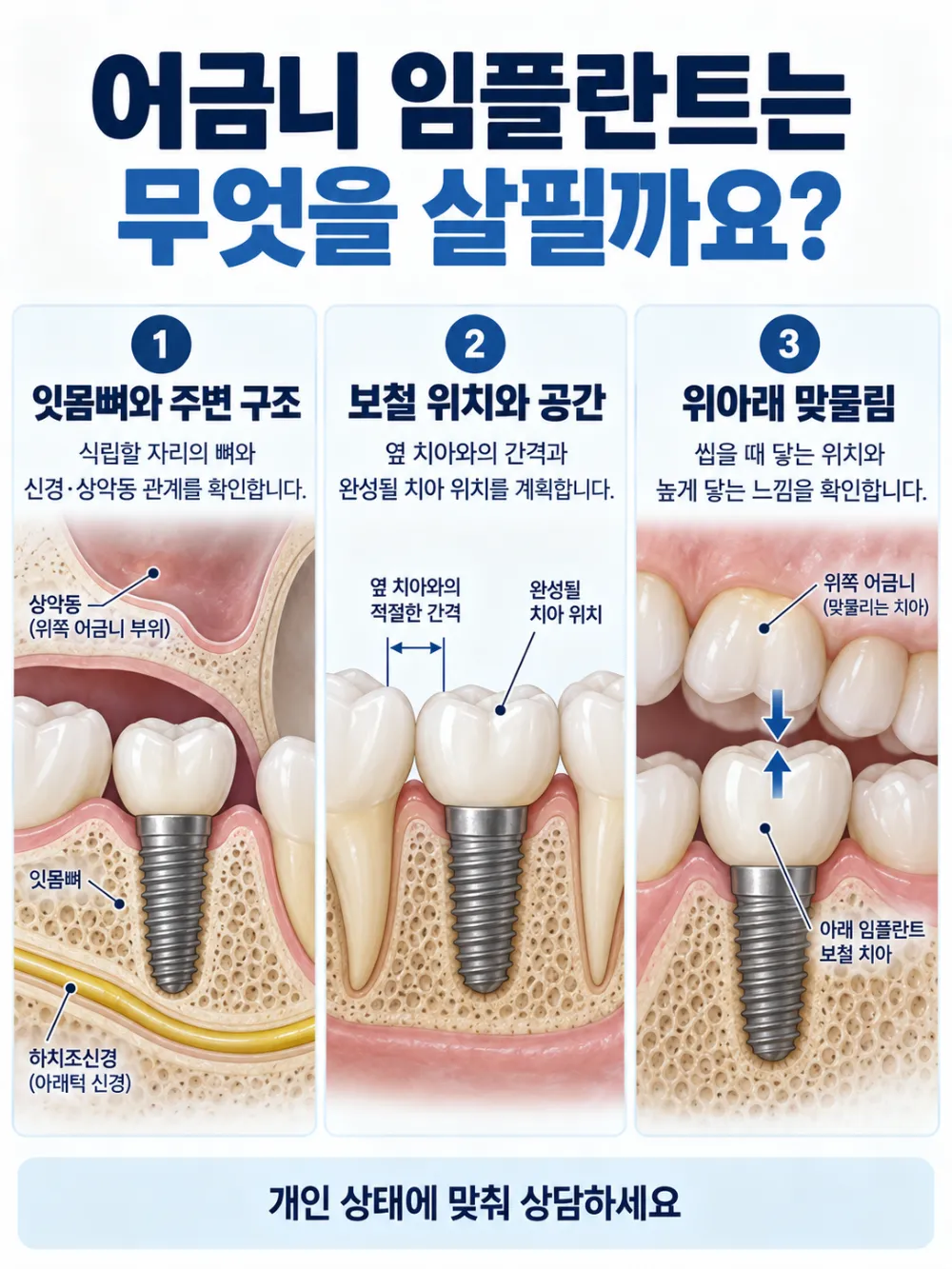 어금니 임플란트는 무엇을 살필까요?: 잇몸뼈와 주변 구조, 보철 위치와 공간, 위아래 맞물림