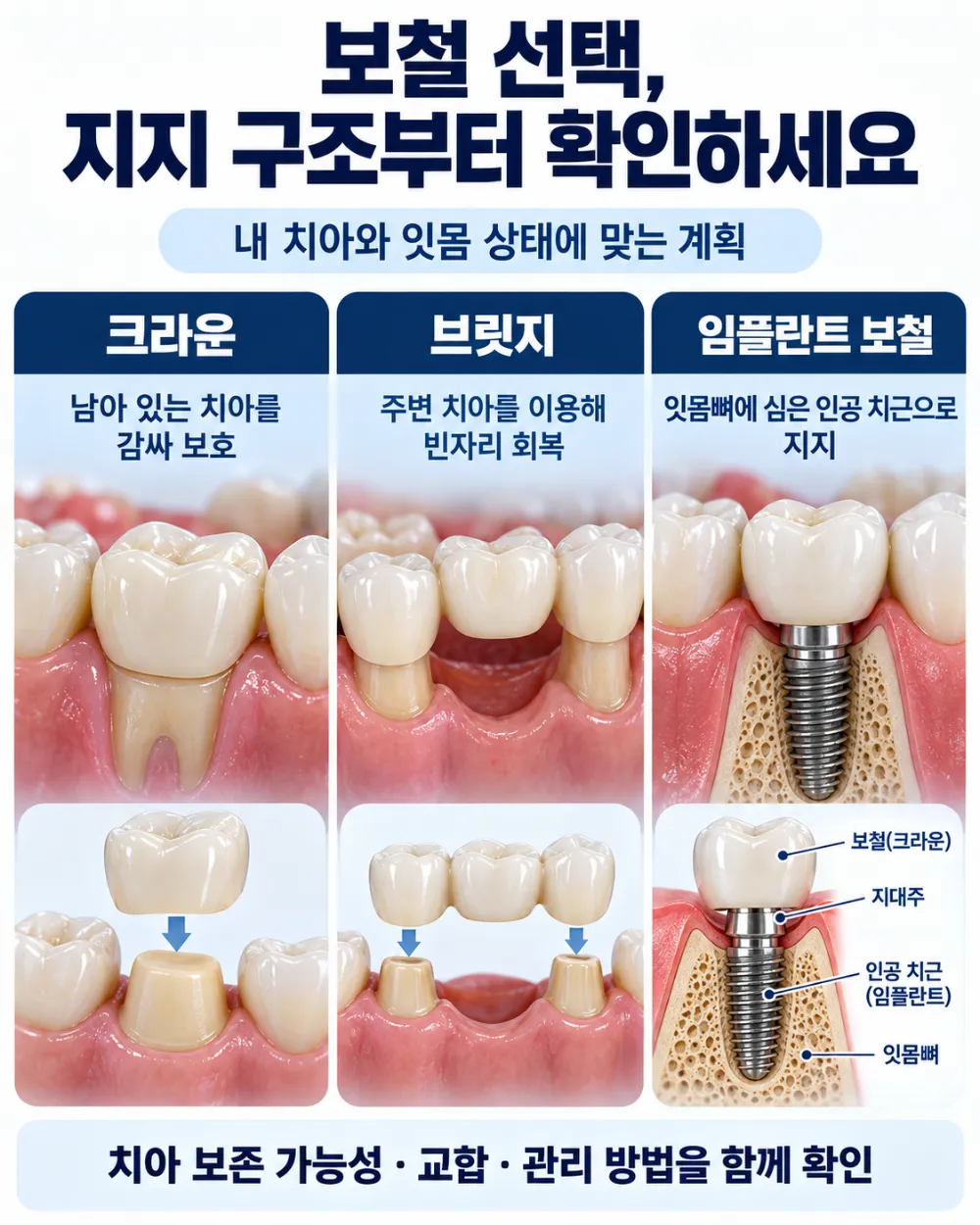 서현역보철추천 상담에서 살펴볼 크라운·브릿지·임플란트 보철의 지지 구조